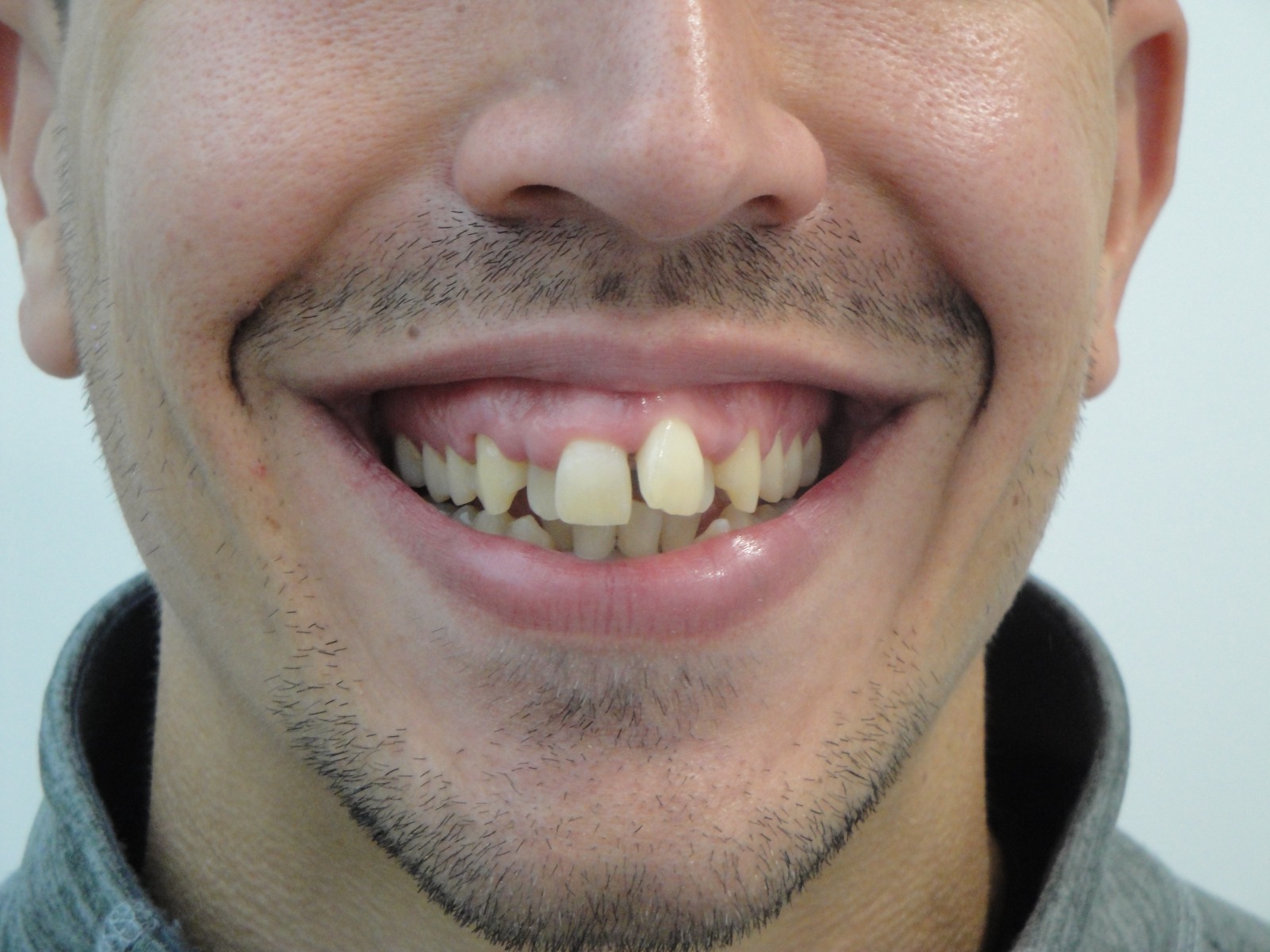 Clínica Dental en Algemesí 22 Ortodoncia en el algemesi antes 1