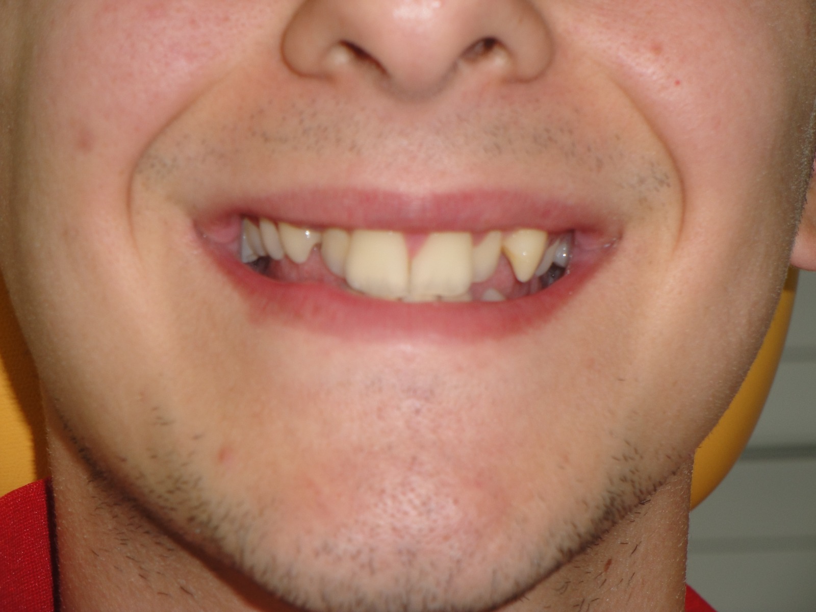 Clínica Dental en Algemesí 20 Ortodoncia en el algemesi antes
