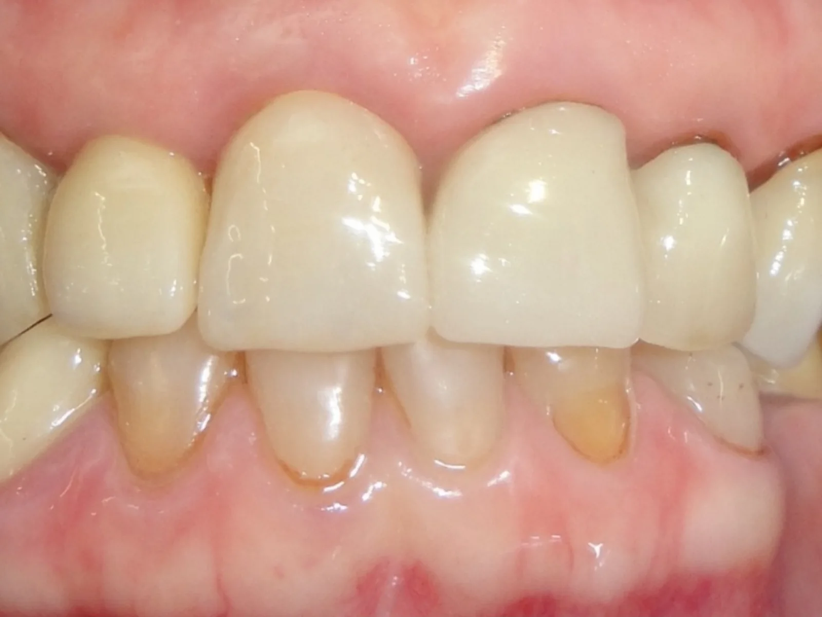 Estética dental en Algemesí: antes del tratamiento