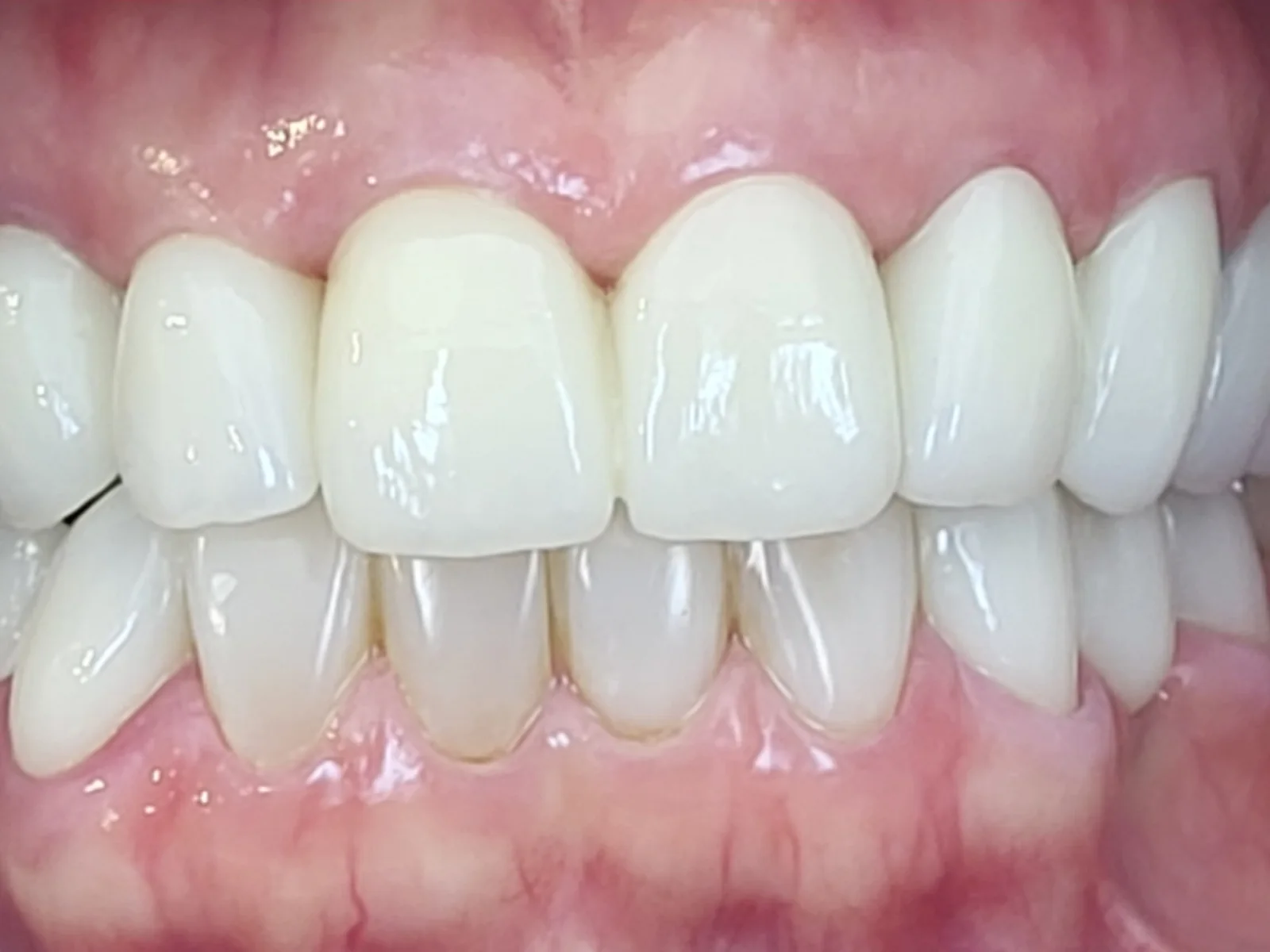 Estética dental en Algemesí: después del tratamiento