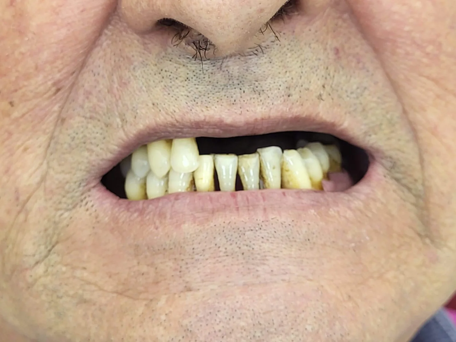 Prótesis dental en Algemesí: antes del tratamiento