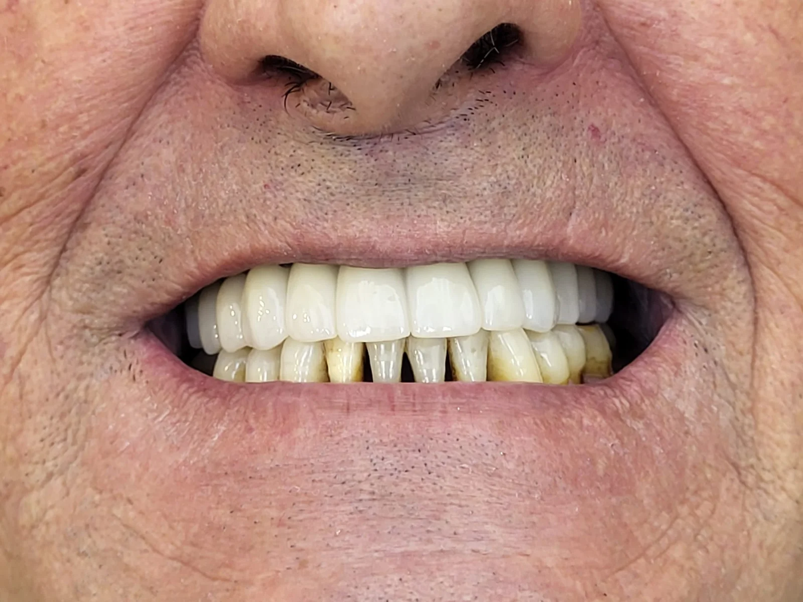 Prótesis dental en Algemesí: después del tratamiento
