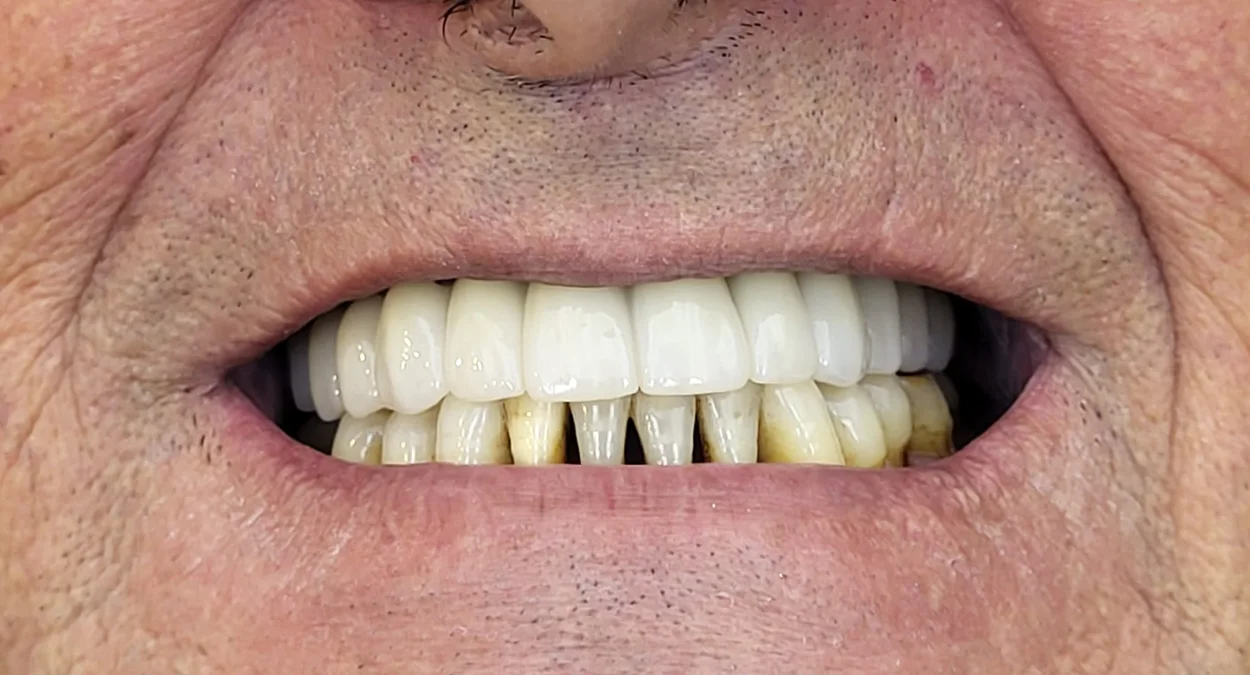 Sonrisa de un paciente con prótesis dental en Algemesí