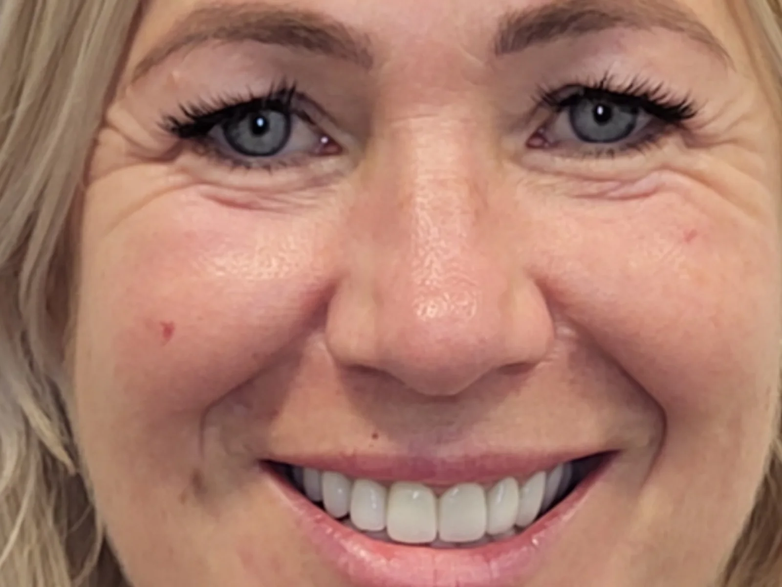 Sonrisa después de un tratamiento de estética dental en Algemesí